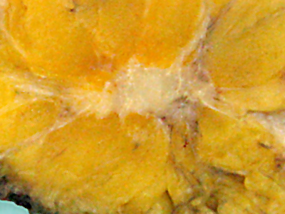 File:Breast cancer gross appearance.jpg