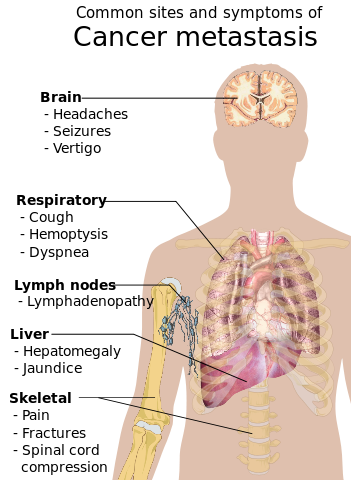 File:Symptoms of cancer metastasis.svg