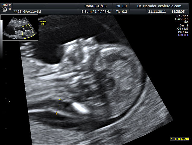 File:Nuchal edema in Down Syndrome Dr. W. Moroder.jpg
